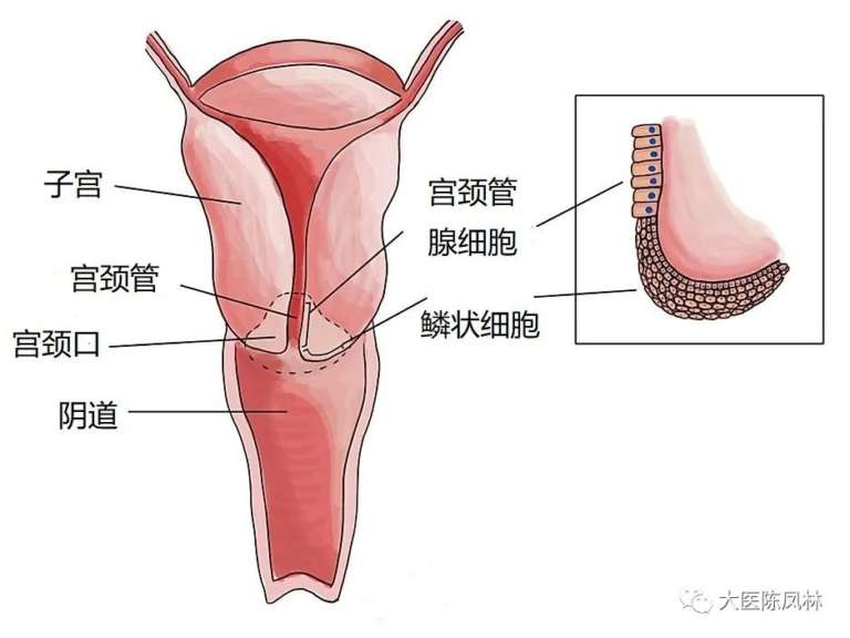 low-grade-squamous-intraepithelial-lesion-lsil-cause-treatment