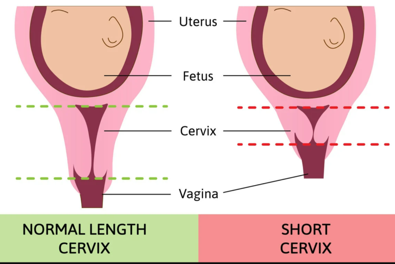 Short Cervix Length Miscarriage Double Antai Cervical Ring Procedure
