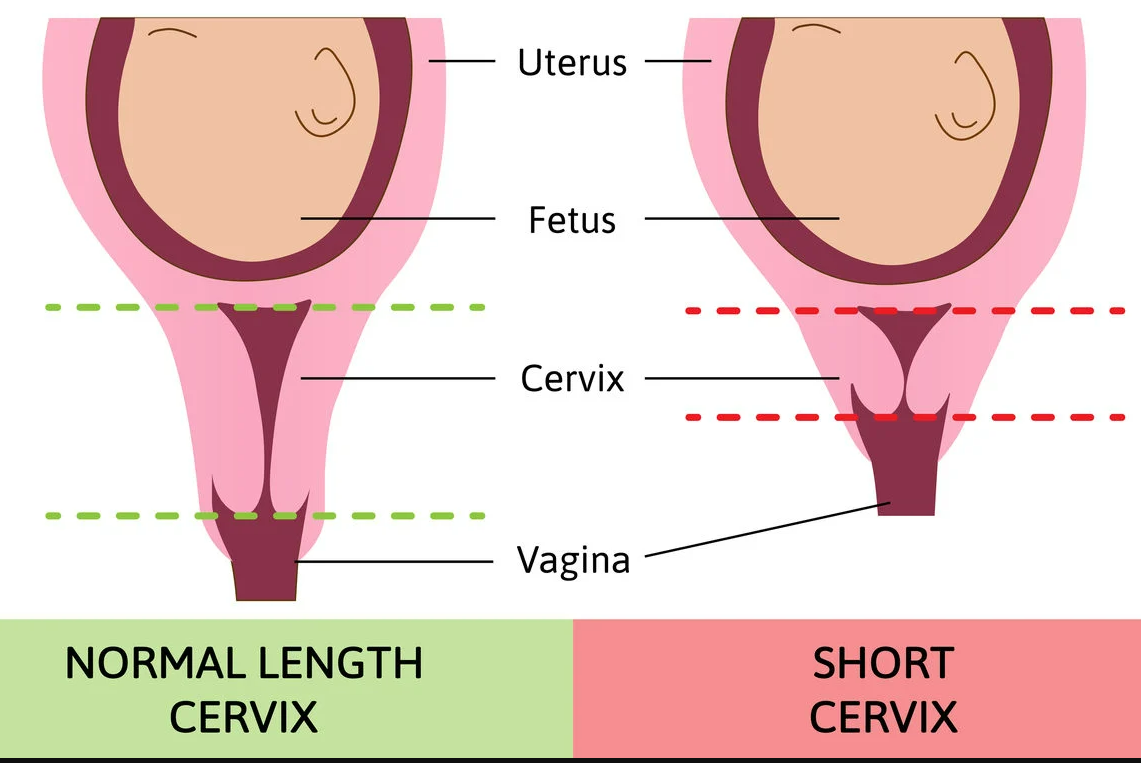 Treating Short Cervix (and Cervical Insufficiency) in Pregnancy