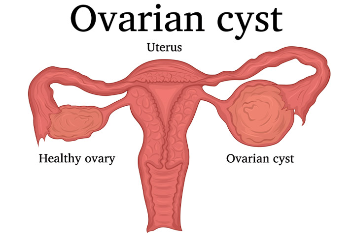 Ovarian Cysts: How do they cause miscarriage? – Antai Hospital - Antai  Hospital - International Patent Miscarriage Specialist
